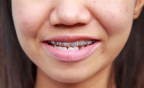 Everything You Need To Know About Underbite Koch Orthodontics