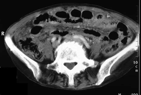 Atypical CT And MRI Manifestations Of Mature Ovarian Cystic Teratomas AJR