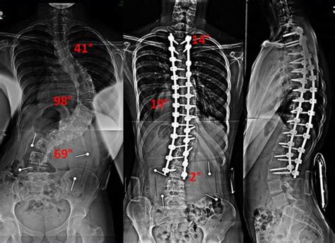 Adolescent Idiopathic Scoliosis Treatment And Surgery Nj And Nyc