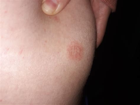 Rash Not Itchy