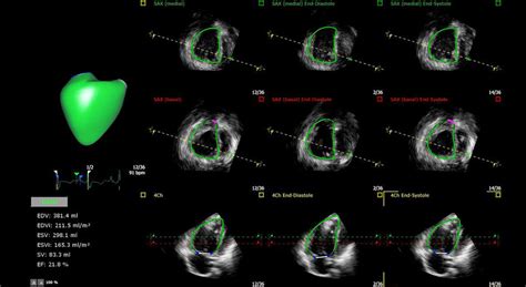 Three Dimensional Echocardiography Of Right Ventricular Volumes And