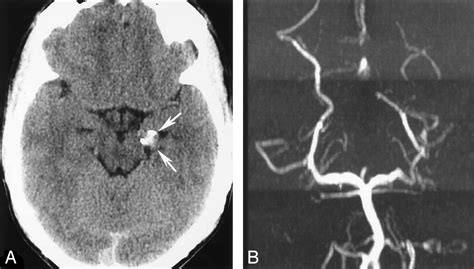 Spontaneous Thrombosis Of A Traumatic Posterior Cerebral Artery