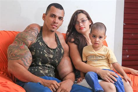 Romario Dos Santos Alves Risks His Life By Injecting Oil Into His Biceps Video Canada