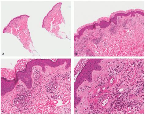 Vasculopathic Vasculitic And Neutrophilic Dermatosis Plastic