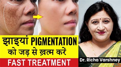 Skin Pigmentation Treatment Home Remedies How To Cure Melasma