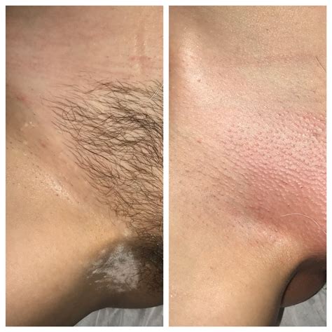 Brazilian Wax Pictures Before And After Porn Photo