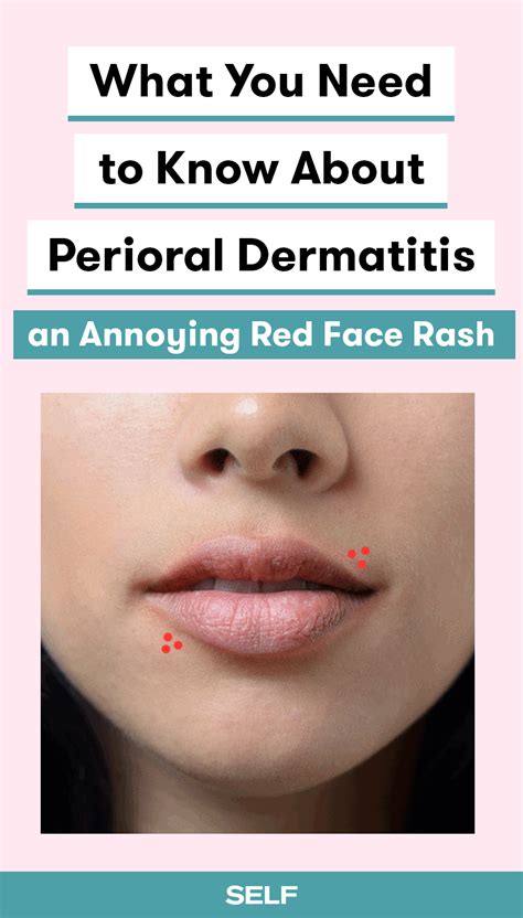 Perioral Dermatitis Might Be Whats Causing Your Red Face Rash Rash