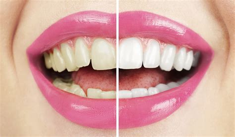 It can also be used for reconstruction, due to accident or injury. New Year, New Smile? Learn About Cosmetic Dentistry