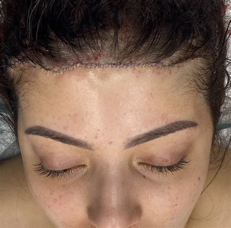 Plastic Surgery Case Study Total Female Forehead Reshaping With