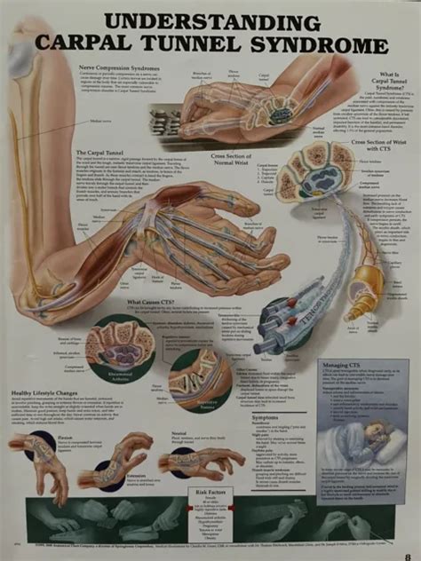Understanding Carpal Tunnel Syndrome Anatomical Chart By Anatomical My XXX Hot Girl