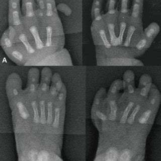 A Postaxial Polydactyly And Syndactyly Are Seen In The Right Hand B Download Scientific