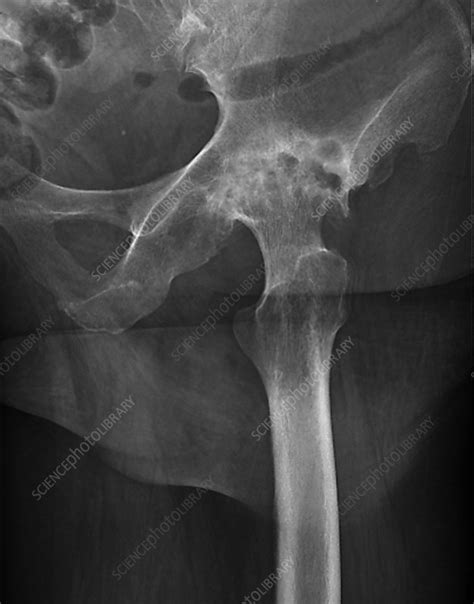 Osteoarthritis Of The Hip X Ray Stock Image C0552491 Science