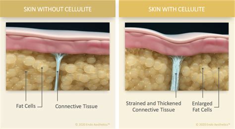 cellulite causes cellulite treatment options qwo san diego