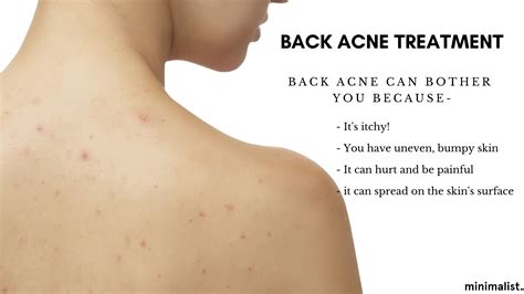 Back Acne Causes Treatment And Prevention Minimalist