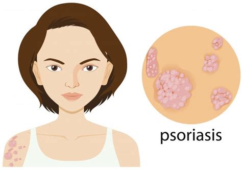 Psoriasis Symptoms Causes Diagnosis Prevention And Treatment Jyoti