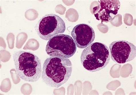 Pathology Outlines Acute Myelomonocytic Leukemia Fab