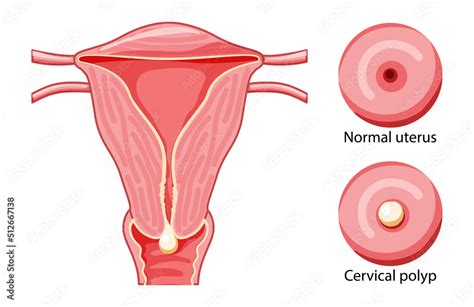 Set Of Cervical Polyp In The Uterus Female Reproductive System In Cross