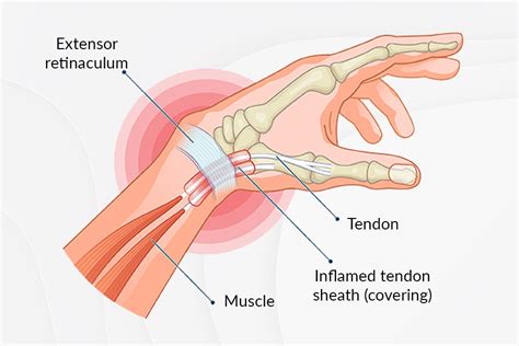De Quervain S Tenosynovitis Symptoms Causes Treatment By Wrist