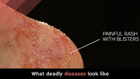 What Deadly Diseases Look Like Alltop Viral