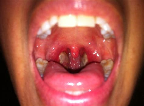 Tonsillitis How To Get Rid Of Them Naturally