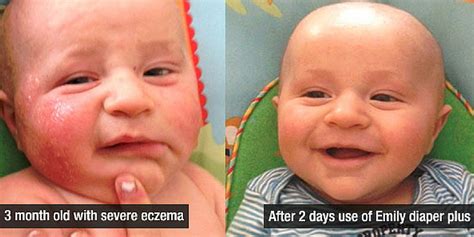 When You Or Your Child Have Facial Eczema It Can Be Extremely Difficult