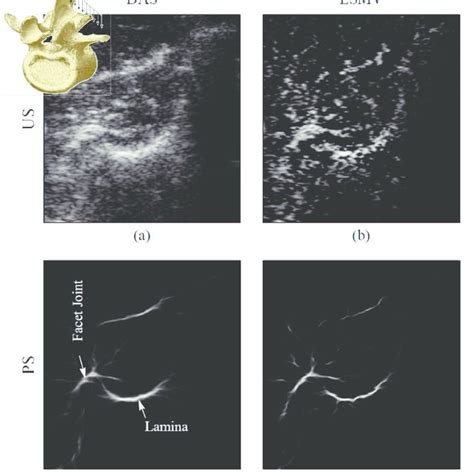 Ultrasound And Ps Post Processed Images Of The Spinous Process In