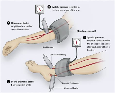 Dopplar Assessment With Apbi Ankle Brachial Pressure Index Mcr Feet