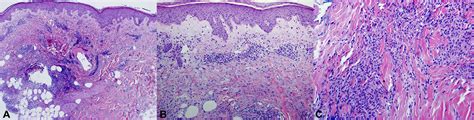 Palisaded Neutrophilic Granulomatous Dermatitis Spectrum Of Histologic
