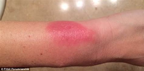 Rashes Blisters Peeling Skin Users Of 130 Dollar Wrist Worn Fitbit