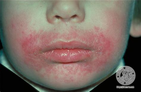 Acne As Related To Dermatitis Pictures