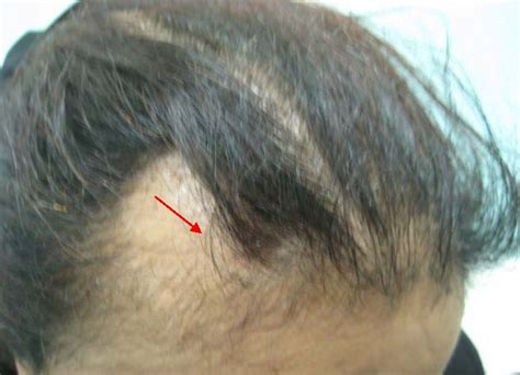 Scalp Problems Scalp Microneedling Hair Loss Treatment Hairple