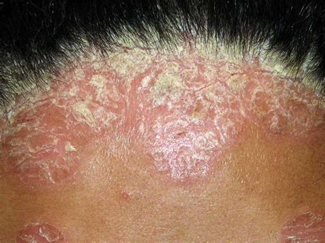 How To Identify And Treat Scalp Psoriasis Medication Junction