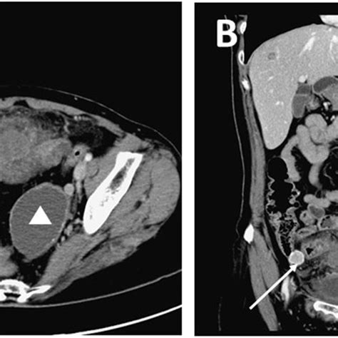 Preoperative Abdominal Ct Transverse View Revealed A A Large