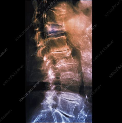 Osteoarthritis Of The Lumbar Spine X Ray Stock Image C Science Photo Library