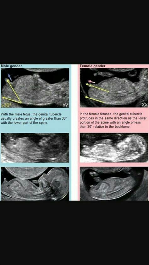 Pin By Nishant Singh On Medical 11 Weeks Pregnant Ultrasound Boy Or