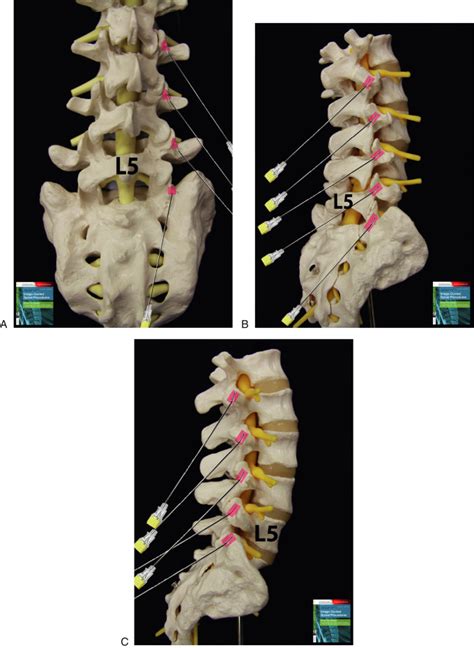 Lumbar Zygapophysial Joint Innervation Anatomy Dissections And