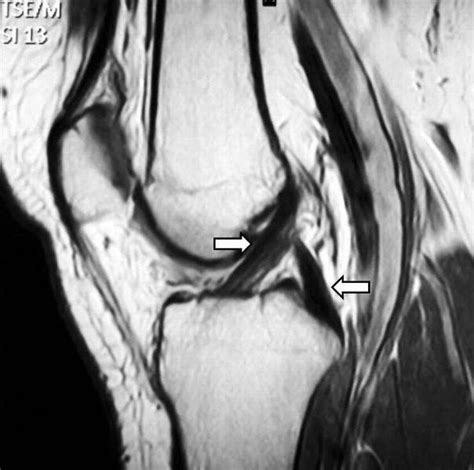 Maybe you would like to learn more about one of these? File:MRT ACL PCL 01.jpg - Wikimedia Commons