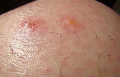 Identify And Control Chiggers