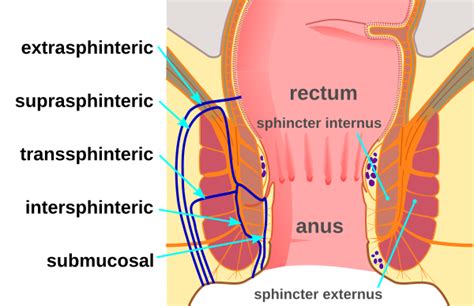 Maladie de Crohn périanale Wikimedica