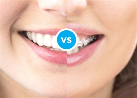 Does invisalign work faster than braces? Invisalign Consultations in Bucks County, PA | Dental Beauty