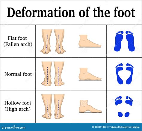 Foot Supination And Pronation Vector Illustration Labeled Medical