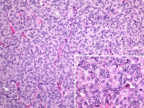 Picture Of A Follicular Patterned Thyroid Neoplasm With Mitosis White