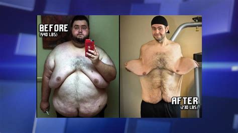 man who lost over 300 pounds gets help for excess skin