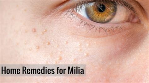 13 Best Ways To Get Rid Of Milia Naturally