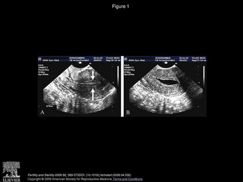 Contrast Ultrasound A Simple To Use Phase Shifting Medium Offers