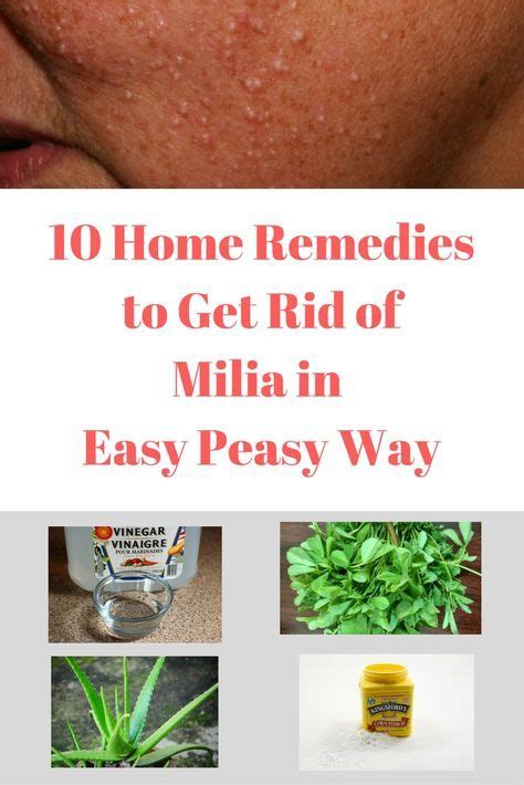 10 Home Remedies To Get Rid Of Milia In Easy Way