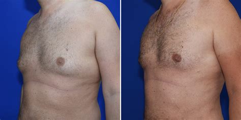 32 Brustimplantate Tropfenform Vorher Nachher Bilder Vorhernachherbilder Eurovenen Bilderhjt