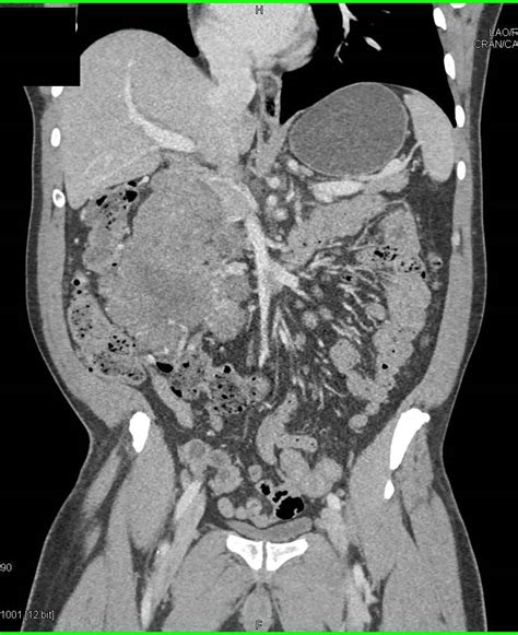 Large Abdominal Gist Tumor With Relationship To The Liver Stomach