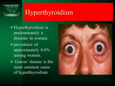 Part Iii Thyroid Disease Awareness Month Hyperthyroidism Strive For