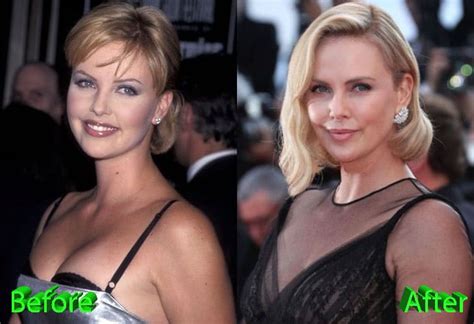 Celebrity Plastic Surgery Before And After Plastic Surgery Photos